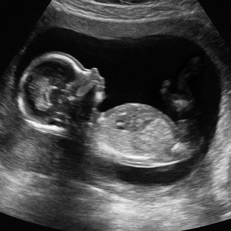 Ultraschallaufnahme einer Schwangerschaft vor einem NIPT-Test bei IVF-SYD in Dänemark